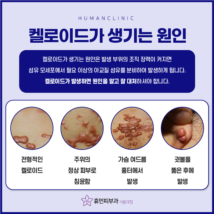 장승배기피부과 켈로이드 알아보려고 한다면? 관련 이미지 3