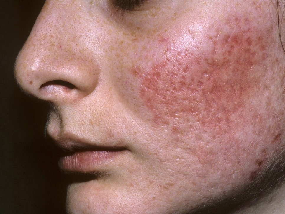 Can Acne Scar Treatment Be Done with Just One Laser Session? image 1