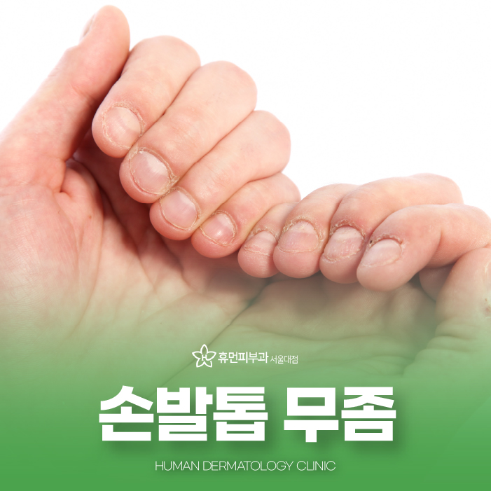 손톱무좀약 어떤 걸 써야 할지 고민이라면? 관련 이미지 1