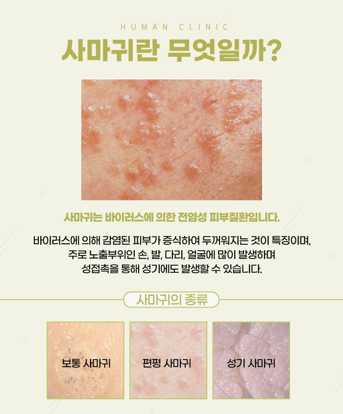 서울대역피부과 사마귀치료 더 심해지기 전에 관련 이미지 2