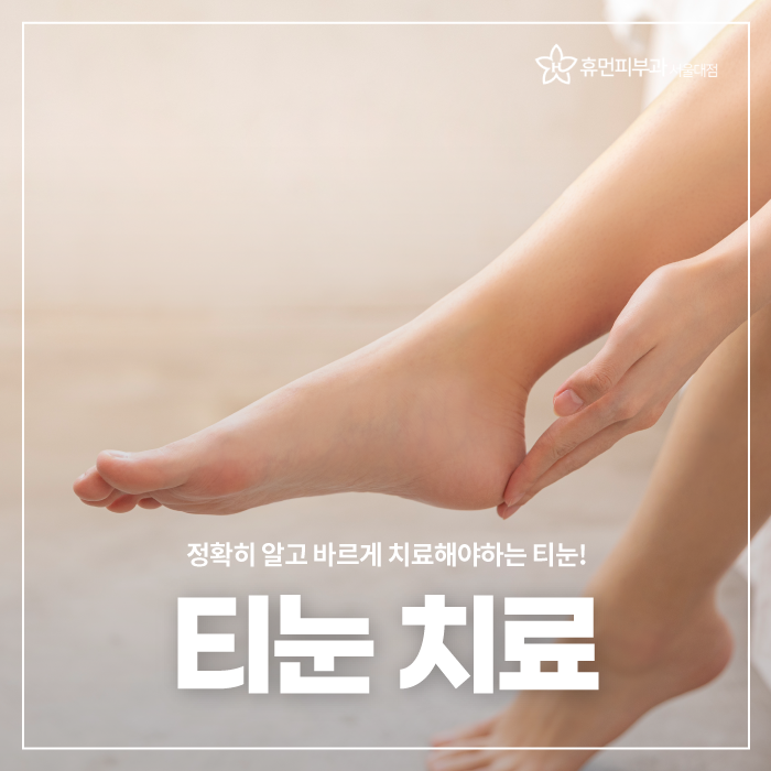 상도역피부과 티눈 정확한 진단으로 관련 이미지 1