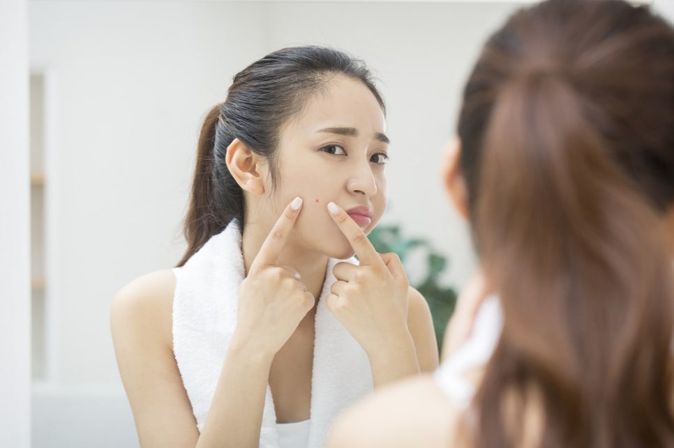여드름 흉터 종류와 관리 방법, 골드 PTT 시술 관련 이미지 2