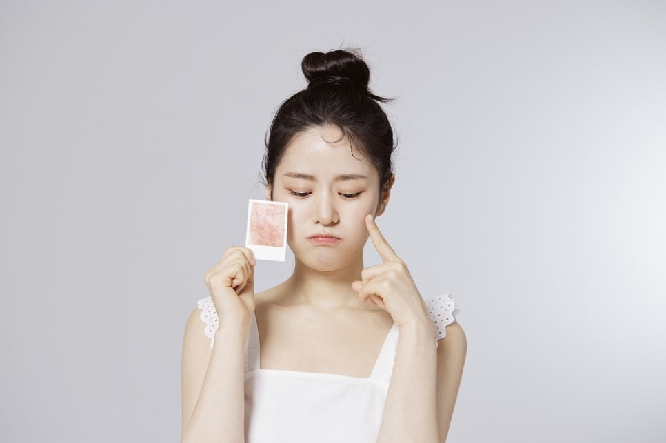 여드름 흉터, 피부과 치료가 필요한 이유 관련 이미지 3