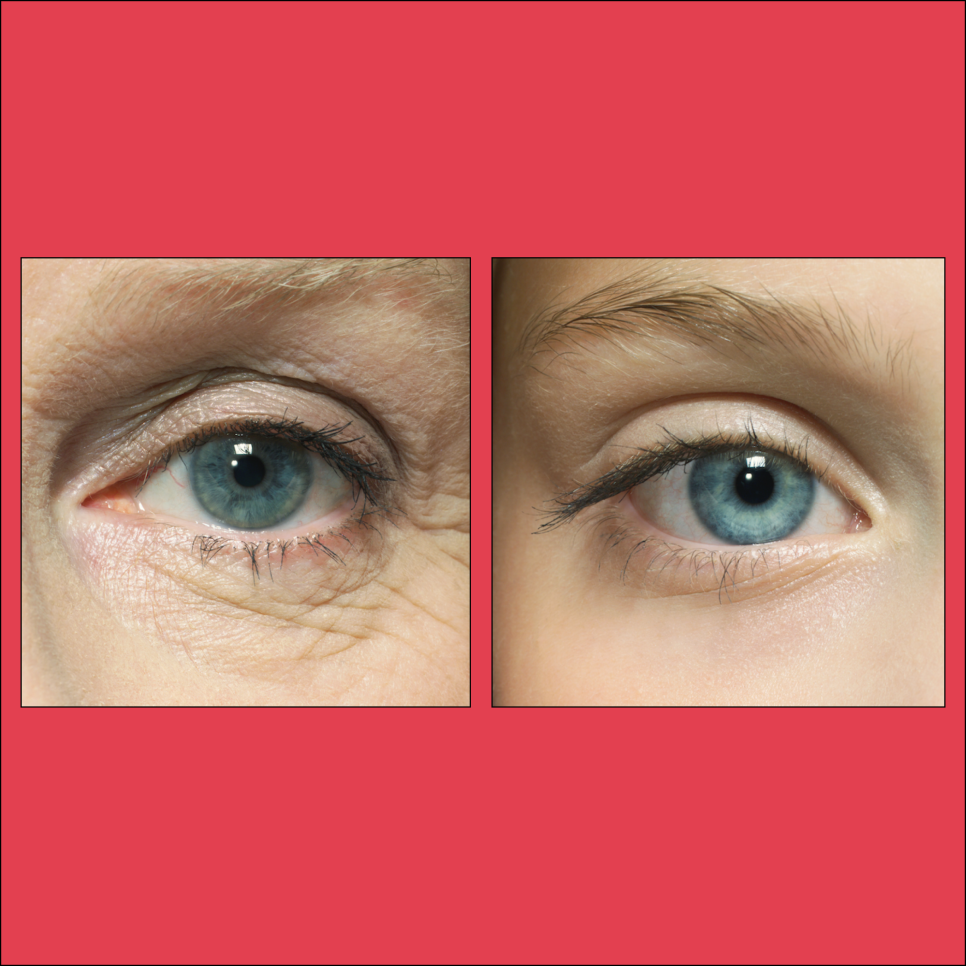Seocho Dermatology: It’s not time for crow’s feet yet... image 1