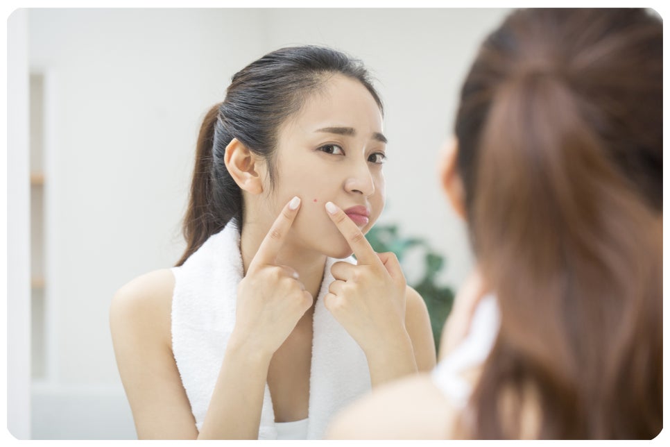 같은 자리에 반복되는 트러블, 여드름 부위별 원인은 다를까요? 관련 이미지 4