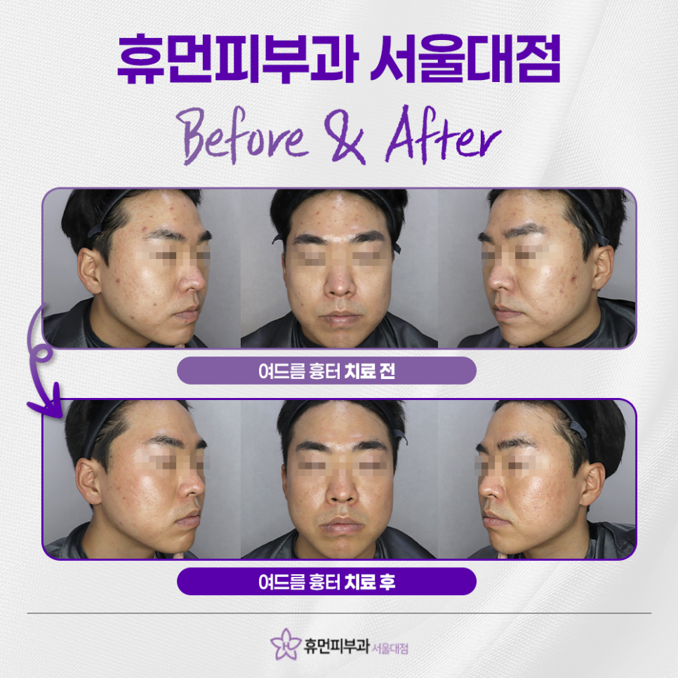 Will Acne Scars Naturally Improve Over Time? image 4