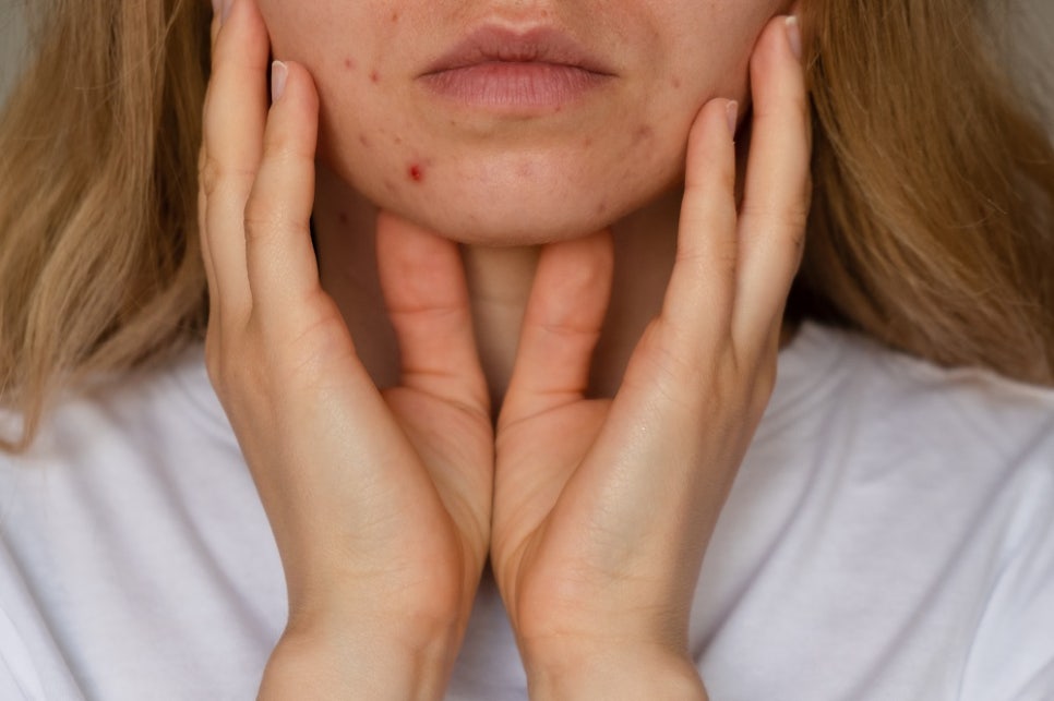Can Acne Scar Treatment Be Done with Just One Laser Session? image 3