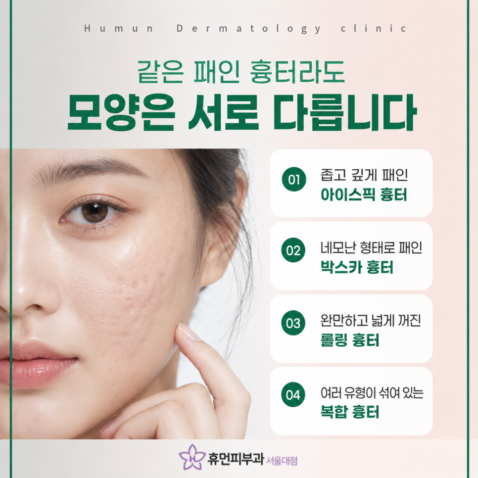 Acne Scars at a Seoul National University Station Dermatology Clinic: Treatment Tailored to Skin Type and Scar Depth image 4