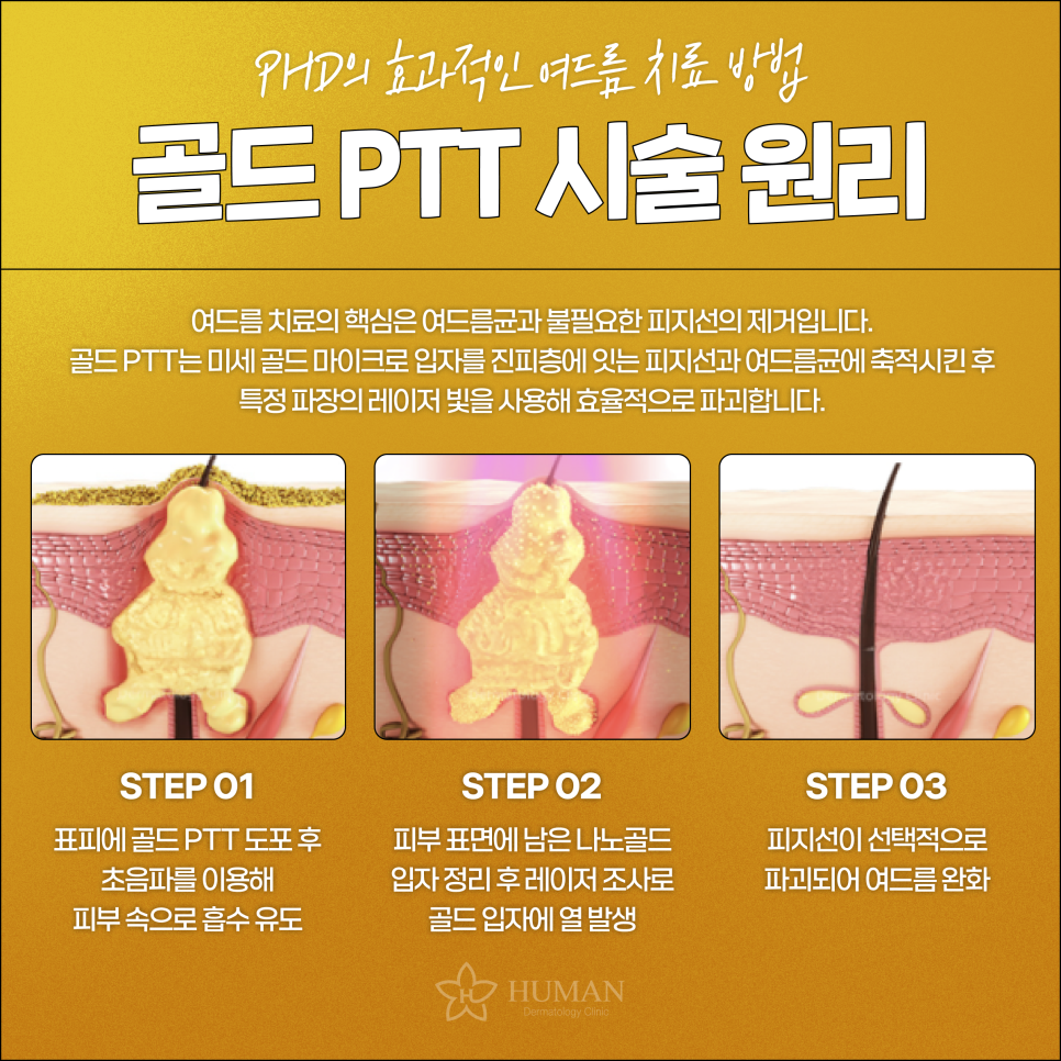 Nakseongdae Station Dermatology: Why You Need to Understand Acne Treatment Properly image 4