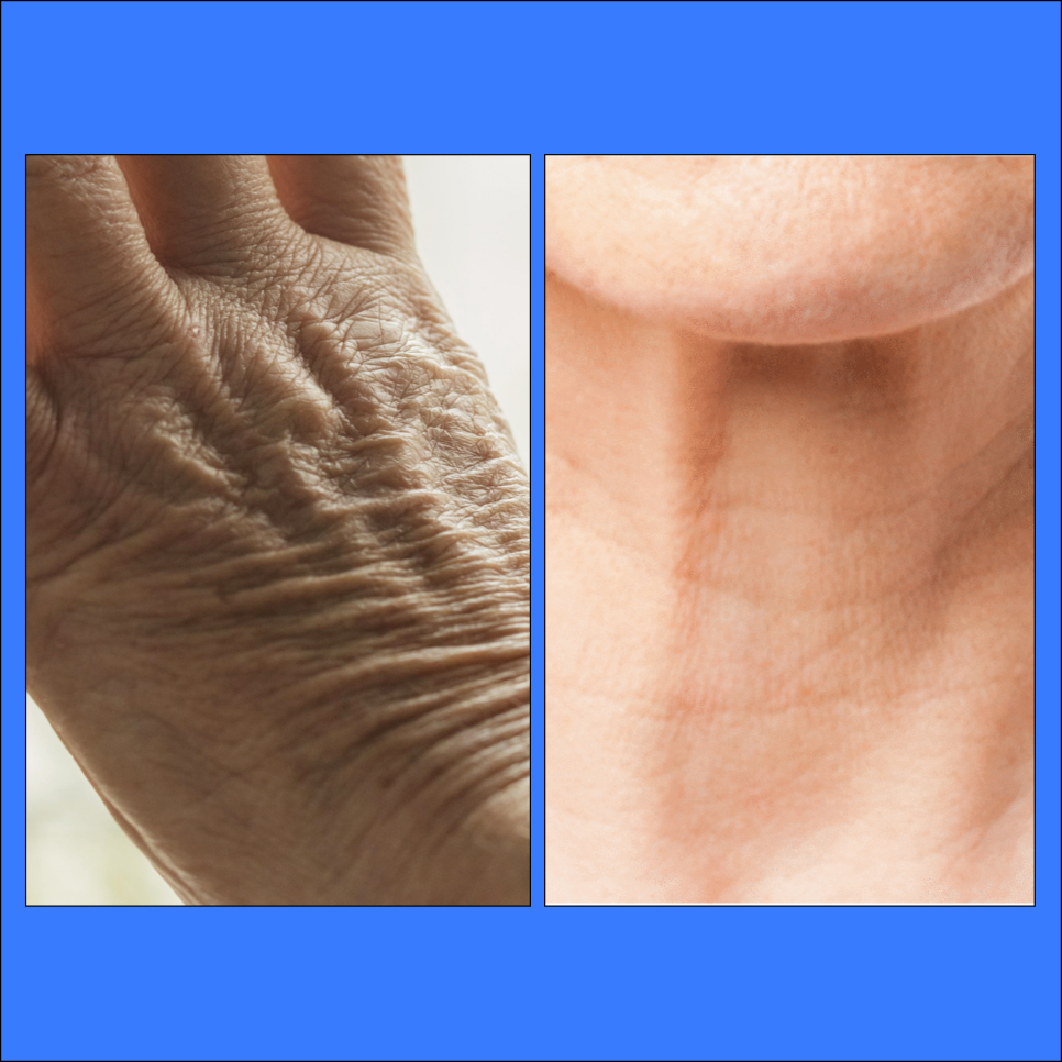 Gwanak Radiesse: When the Volume on the Back of Your Hands Disappears, Your Age Can’t Be Hidden image 1