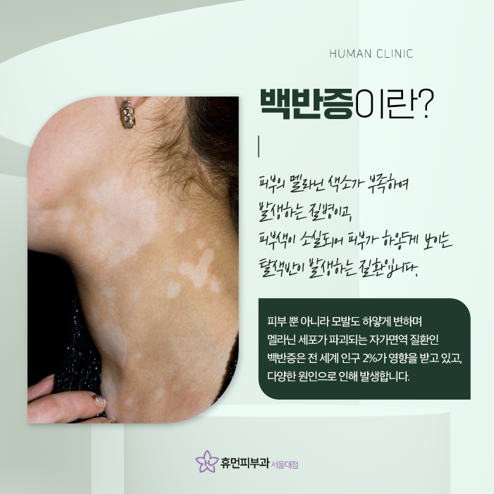 이수역피부과 백반증치료백반증원인을 알아보고 치료할 수 있는 방법은 관련 이미지 2