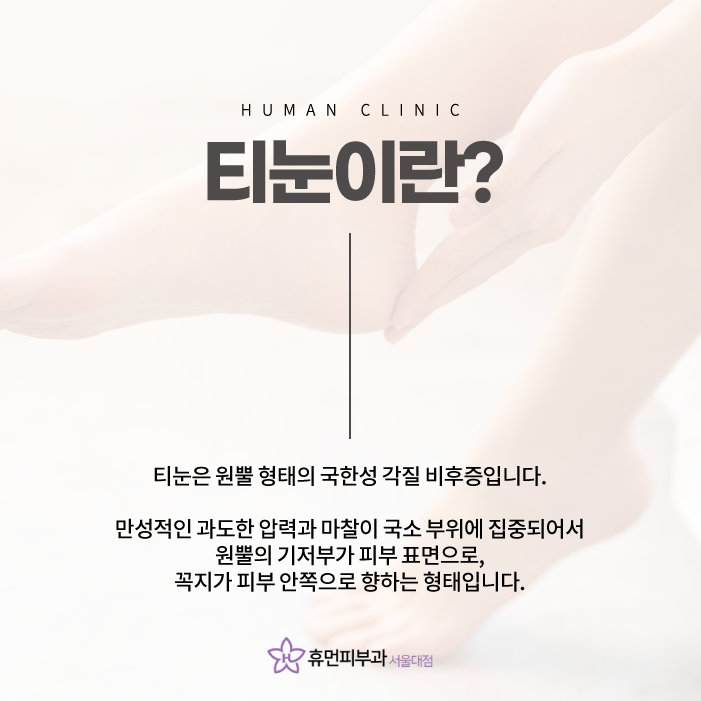 상도역피부과 티눈 정확한 진단으로 관련 이미지 2
