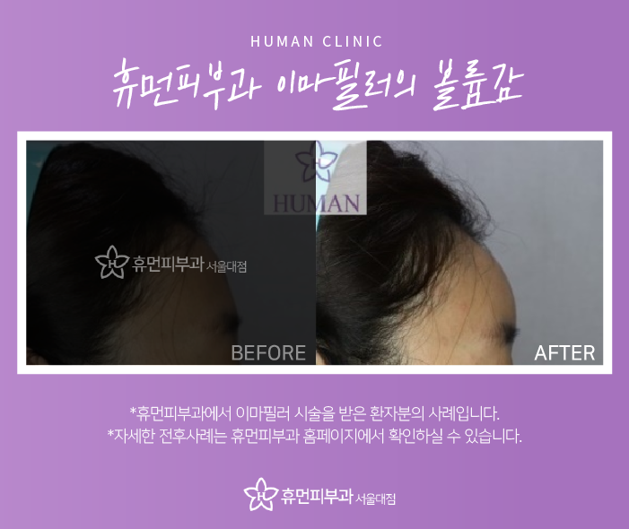 이수역피부과 이마필러로 자연스러운 볼륨감 관련 이미지 6