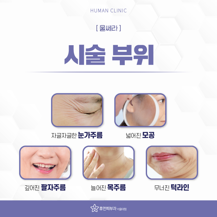 상도동피부과 처진 얼굴살 개선 방법은 무엇일까? 관련 이미지 5