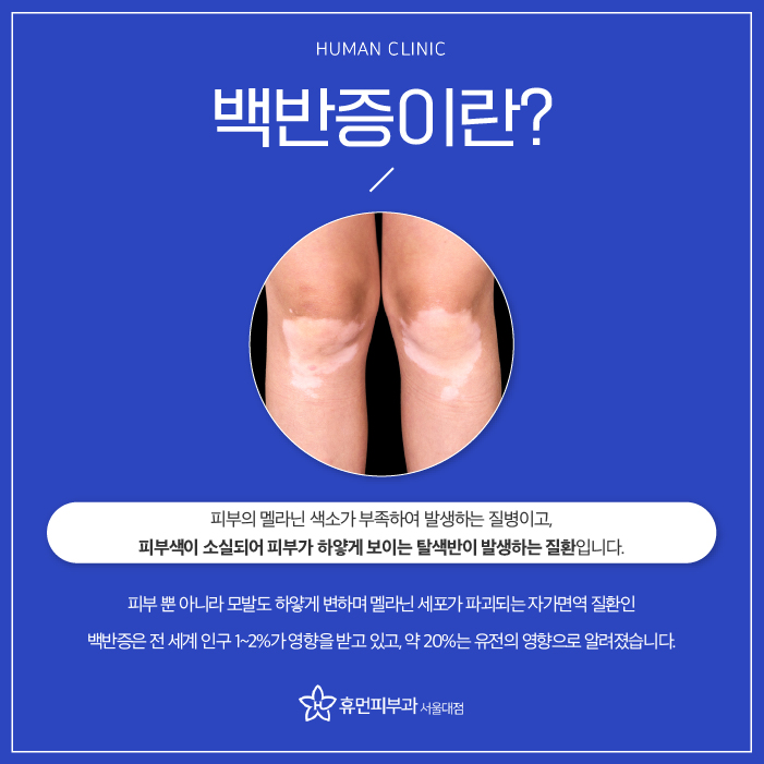서울대입구역피부과 백반증 치료하고 싶다면? 관련 이미지 2