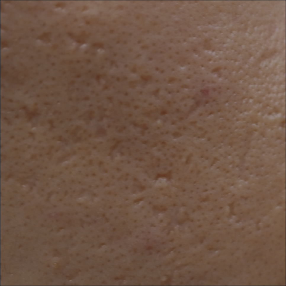 Are Acne Scars in SNU Entrance Just Going to Stay There? image 3