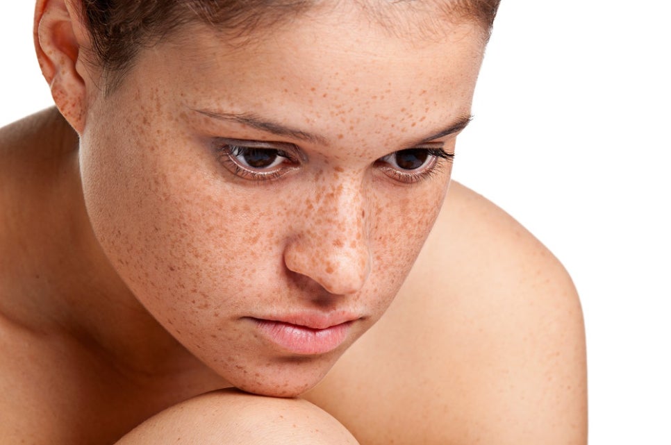 Why Freckles Keep Increasing image 3