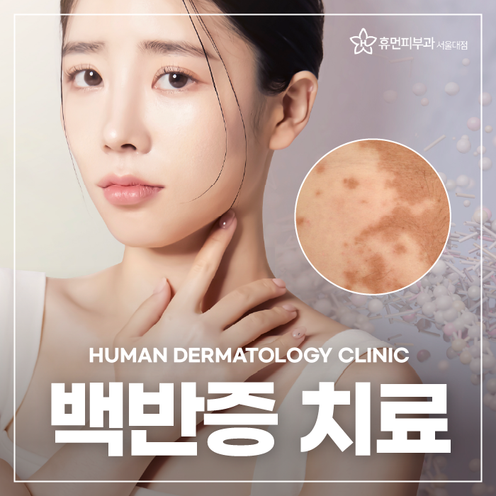 서울피부과추천 백반증은 어떻게 치료할까요? 관련 이미지 1