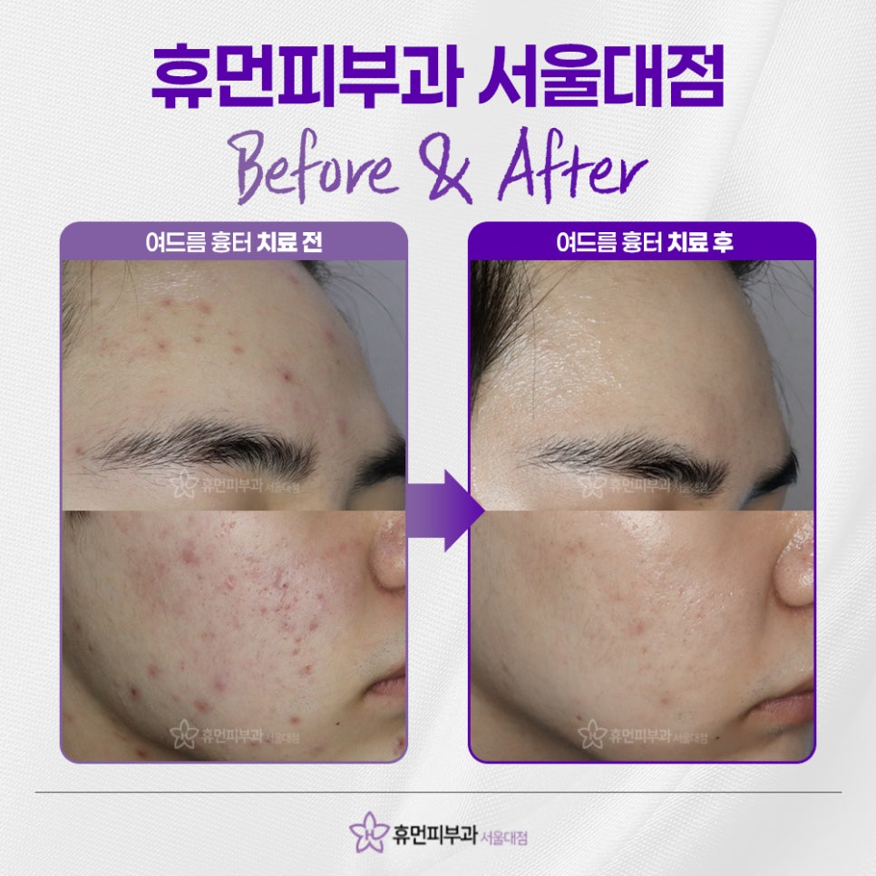 Will Acne Scars Naturally Improve Over Time? image 5