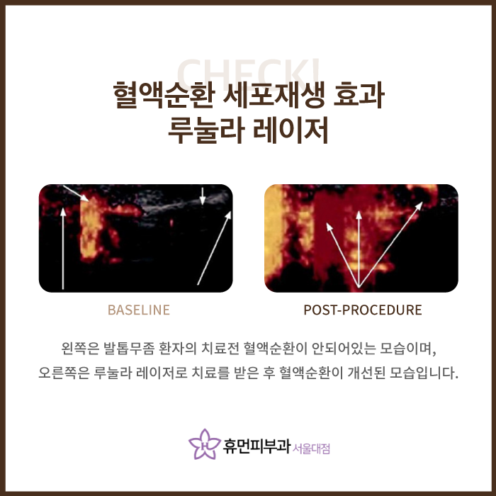 관악구피부과 손발톱 무좀치료 부담없이 관련 이미지 8