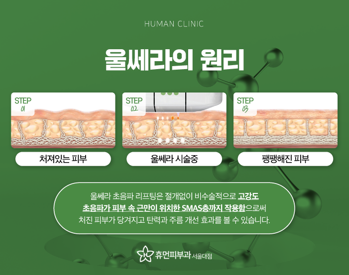 문래동피부과 울쎄라가격 효과로 주름 없는 얼굴 동안 이미지 만들어보자 관련 이미지 4