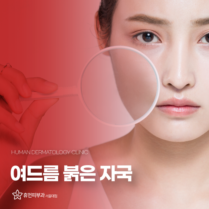 여드름자국레이저 여드름 제네시스 브이빔 LDM으로 여드름관리 해보자 관련 이미지 1
