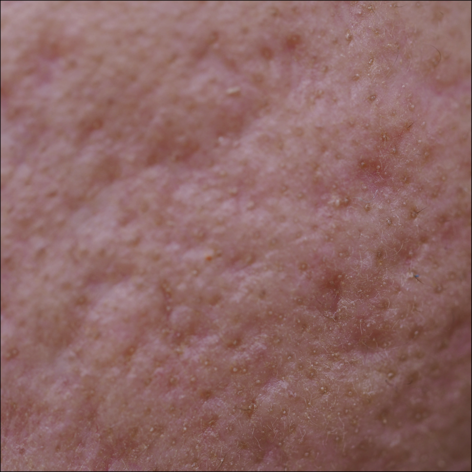 Are Acne Scars in SNU Entrance Just Going to Stay There? image 7