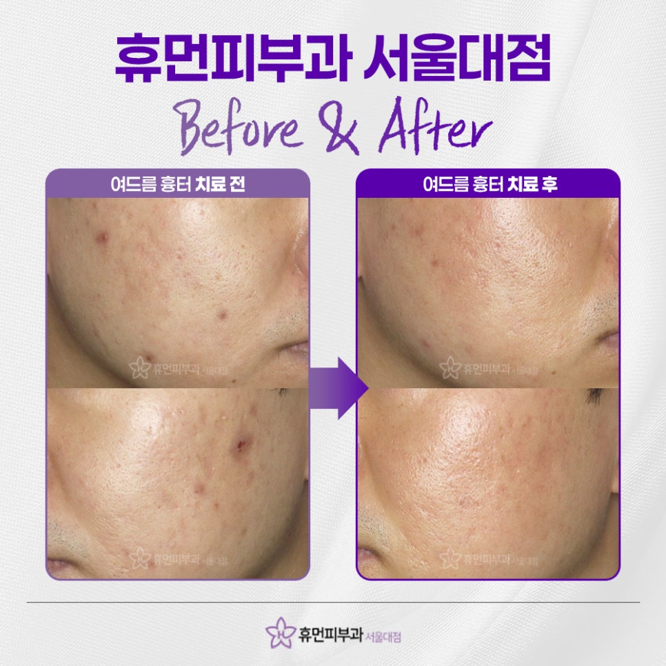 Why Does Acne Keep Coming Back? When Dermatological Treatment Is Needed image 5
