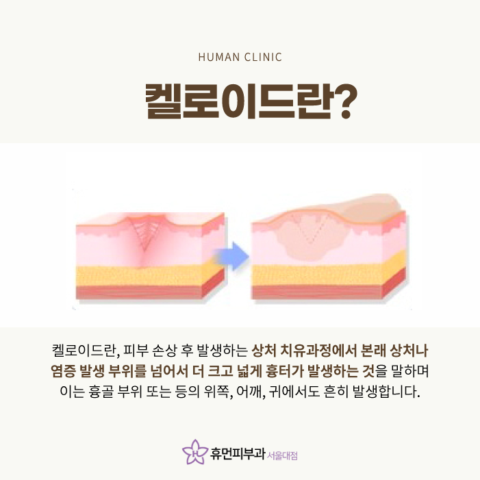 켈로이드피부과 어떻게 치료하나요 관련 이미지 2