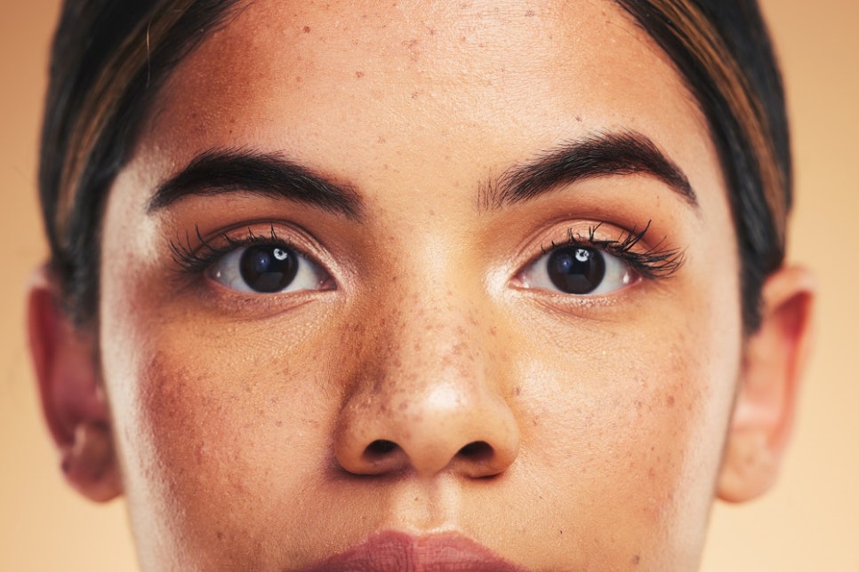 Why Freckles Keep Increasing image 4
