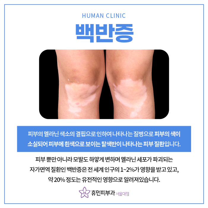 서울대입구역피부과 백반증 고민된다면? 관련 이미지 2