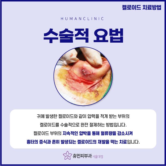 장승배기피부과 켈로이드 알아보려고 한다면? 관련 이미지 6