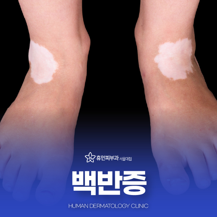 서울대입구역피부과 백반증 치료하고 싶다면? 관련 이미지 1