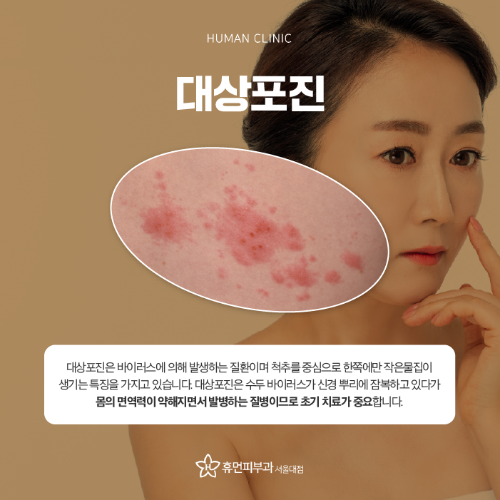 구로디지털단지피부과 대상포진병원 대상포진초기증상 바로 알고 빠른 시기 내에 회복을 관련 이미지 2