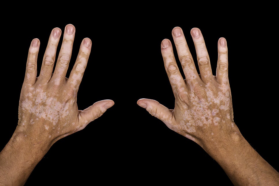 What Are the White Spots That Appear on the Skin? Vitiligo image 3