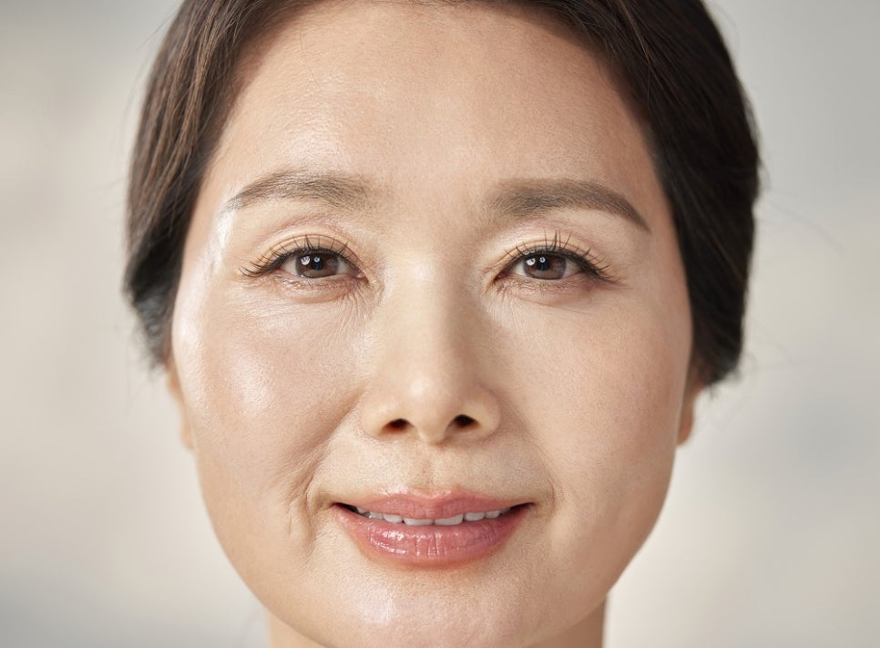 When You Need to Manage Smile Lines That Stand Out Even When You’re Not Moving image 4