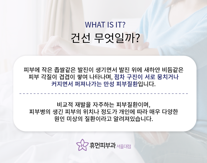 난곡동피부과 백반증과 건선 방치하지마세요 관련 이미지 5