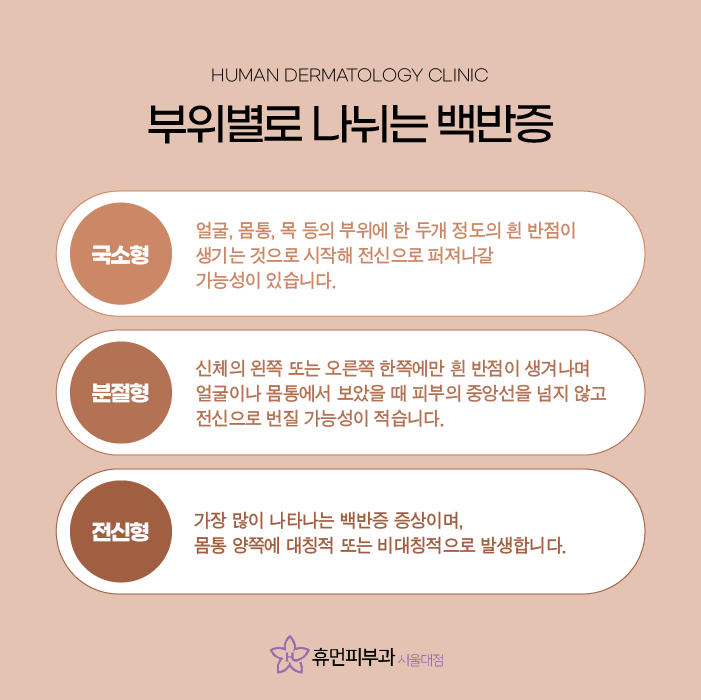 서울피부과추천 백반증은 어떻게 치료할까요? 관련 이미지 4