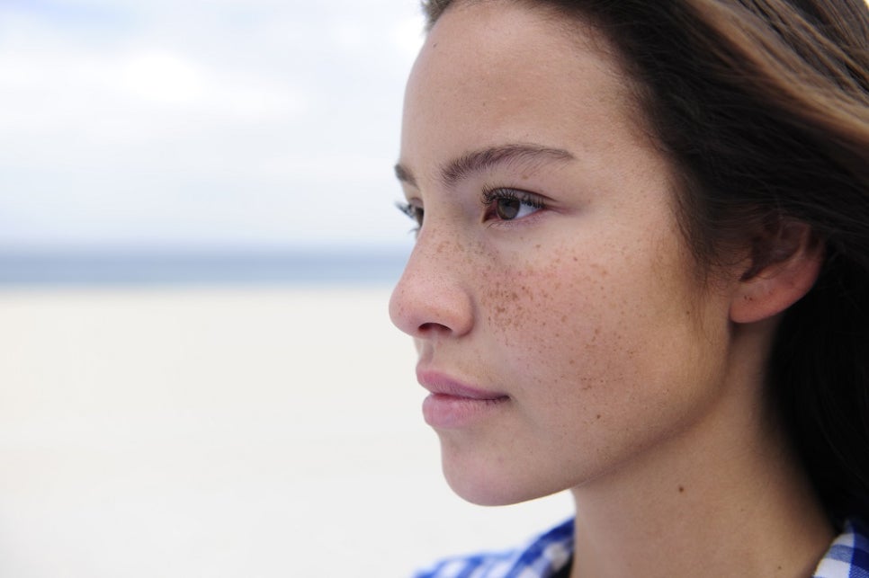 Why Freckles Keep Increasing image 2