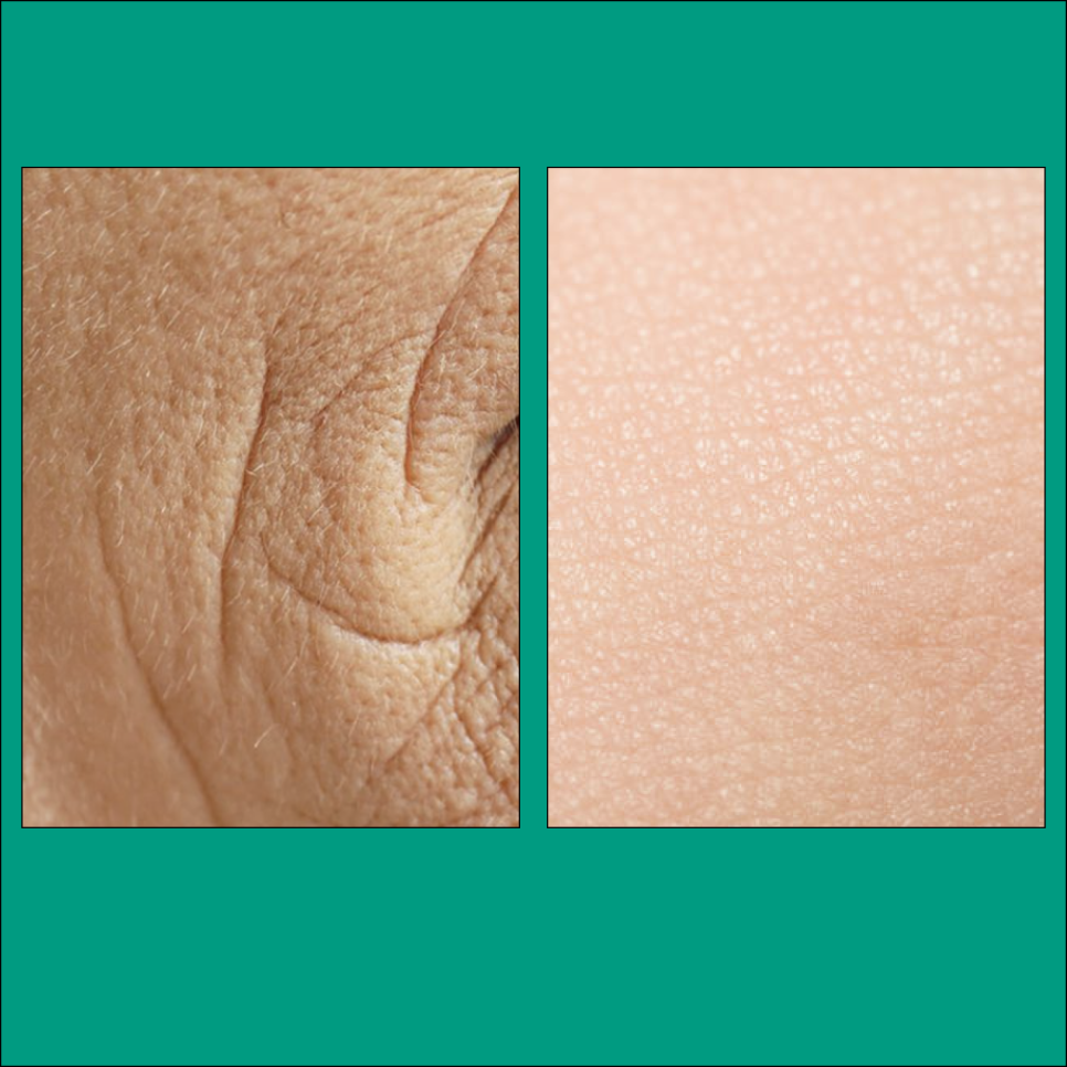 Sadang-dong Dermatology: Deepening Crow’s Feet Wrinkles Can Be Improved with 000 image 7