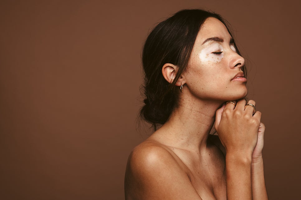 What Are the White Spots That Appear on the Skin? Vitiligo image 2