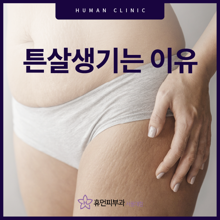 튼살이 생기는 이유와 관리법이 궁금하다면 관련 이미지 1
