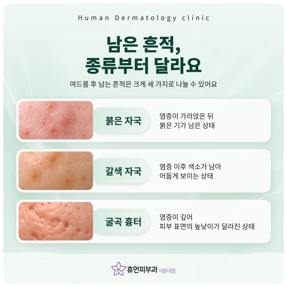 서울대입구피부과 여드름흉터, 자국일까 흉터일까 먼저 구분해요 관련 이미지 3