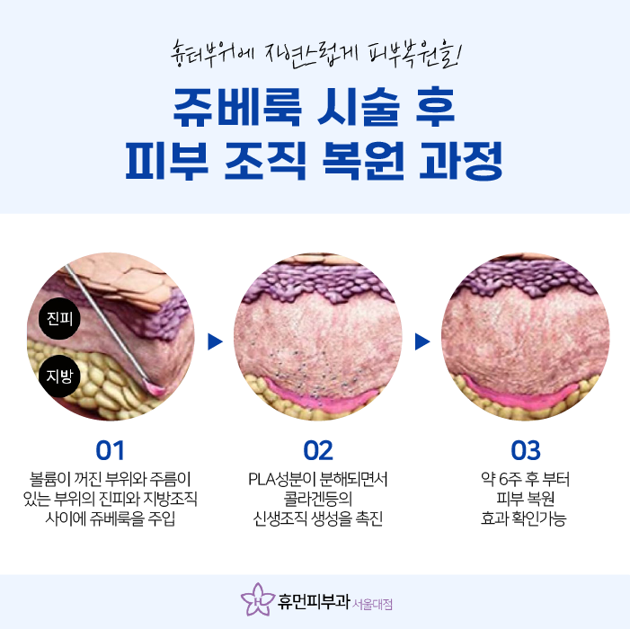 봉천역피부과 여드름 흉터 치료 말끔하게 관련 이미지 3