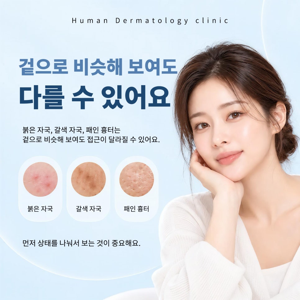 서울대입구피부과 여드름흉터, 자국과 패임을 먼저 나눠서 보는 이유 관련 이미지 3