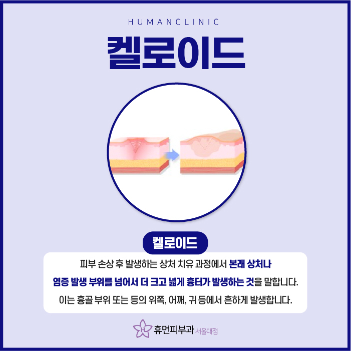 장승배기피부과 켈로이드 알아보려고 한다면? 관련 이미지 2