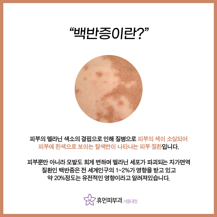 서울피부과추천 백반증은 어떻게 치료할까요? 관련 이미지 2