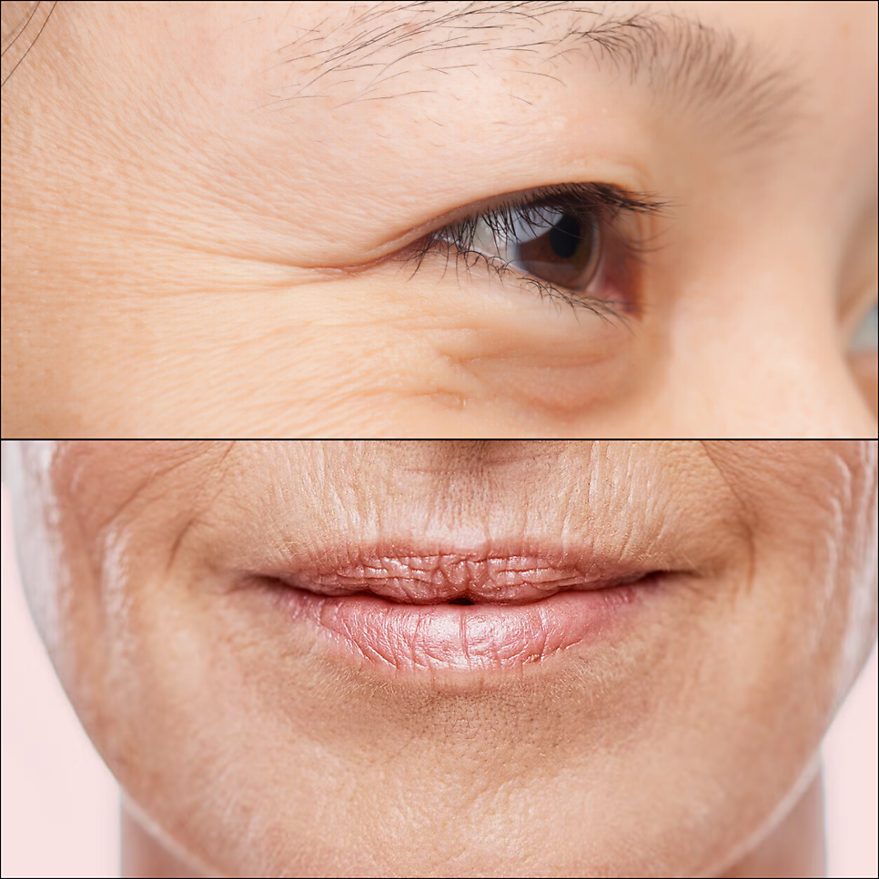 Sadang-dong Dermatology: Deepening Crow’s Feet Wrinkles Can Be Improved with 000 image 1