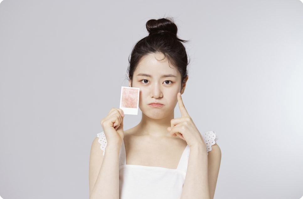 여드름 붉은자국, 여드름은 가라앉았는데 왜 계속 남아 있을까요? 관련 이미지 2