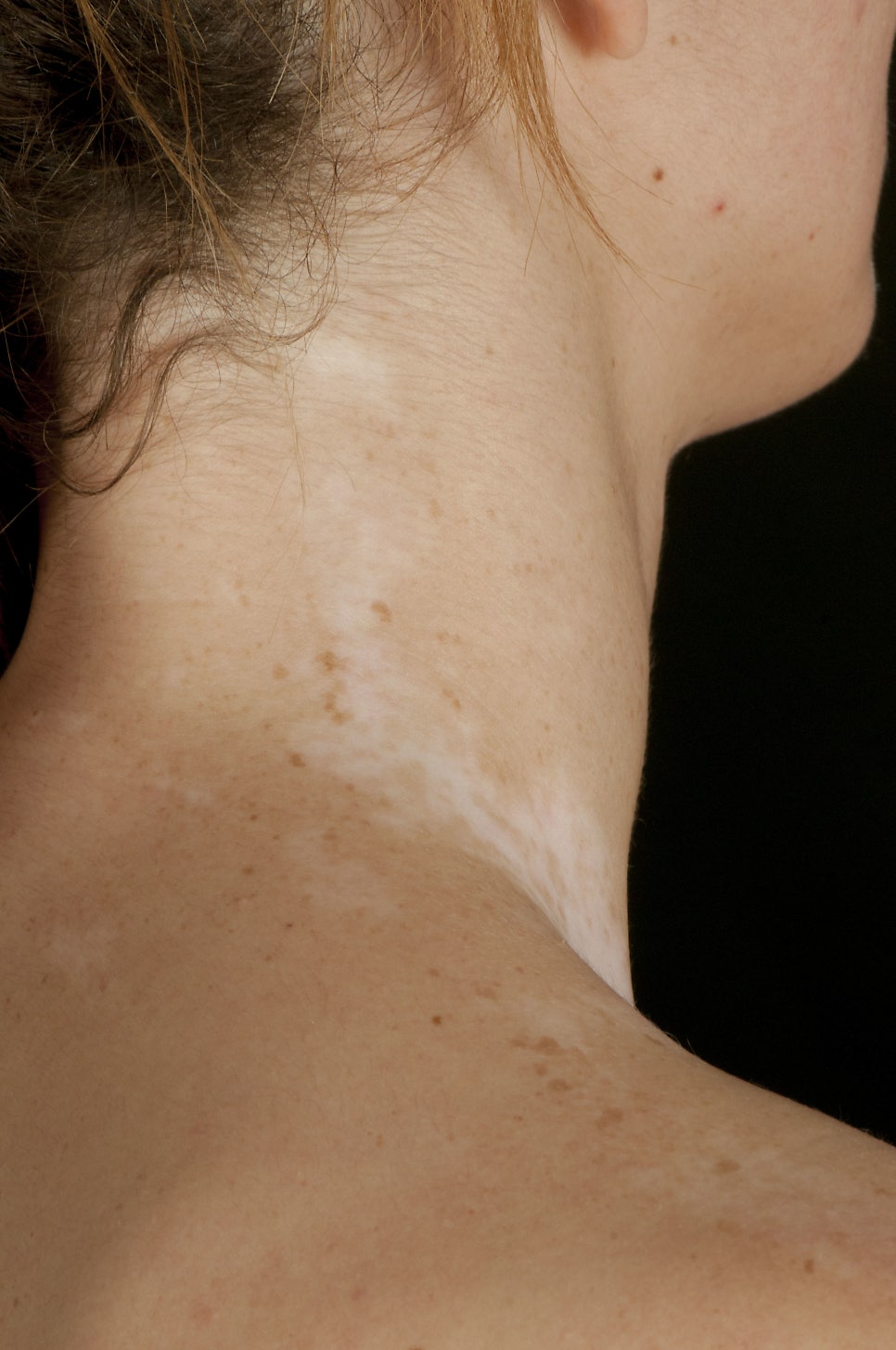 What Are the White Spots That Appear on the Skin? Vitiligo image 5